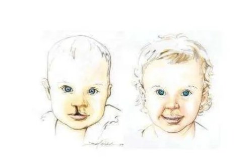 深圳唇裂修复必看！李俊医生术后真实实例：从自卑到自信！