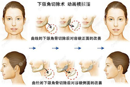 陈小平面部轮廓手术价格表!颧骨颧弓/下颌角整形/轮廓三件套收费价目表全公开