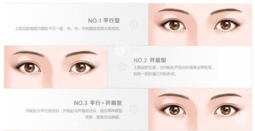 孝感做双眼皮要多少钱？埋线 / 全切 / 眼综合等价格表曝光，附各项目收费详情