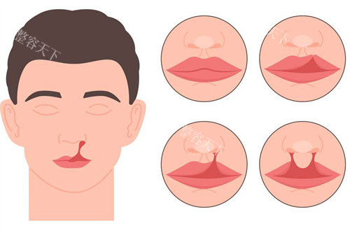深圳唇裂修复必看！李俊医生术后真实实例：从自卑到自信！