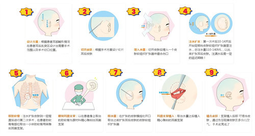 重庆松山徐铎耳再造技术：Su-por支架一次成型，术后无痕的详细解析！
