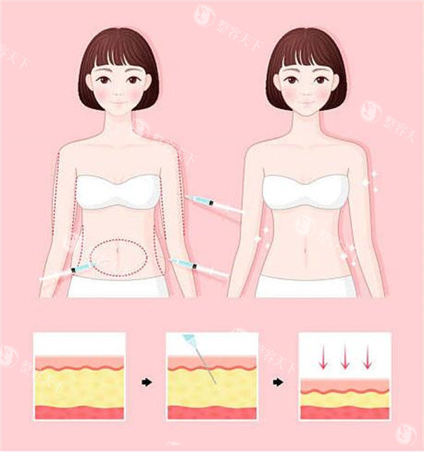 人鱼体雕西安哪家医院好？3s医美技术+医生团队全解析！