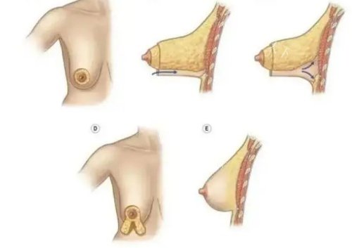 乳房悬吊提升郑州价格表！轻度/中度/重度下垂费用对比！
