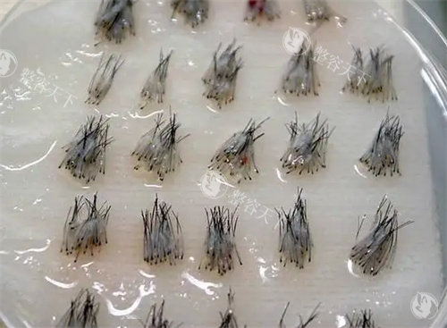 长沙惠丰植发科怎么样?是很成熟的植发专科医院！