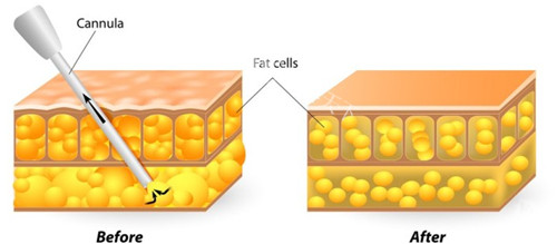 冯斌脂雕靠谱吗？深入解析冯斌医生个人资料，揭秘其脂肪丰胸的显著结果与良好口碑，为你呈现脂雕的靠谱真相