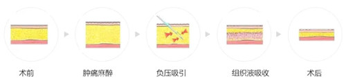 成都吸脂潘勇医生简介！吸脂采用多个技术、有多年的经验、吸脂成效明显、网友好评不断~