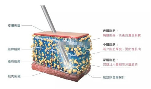 成都吸脂潘勇医生简介！吸脂采用多个技术、有多年的经验、吸脂成效明显、网友好评不断~