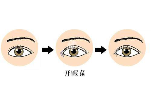 长沙珀斐杨琪医生做眼部整形怎么样？技术很成熟审美很自然！