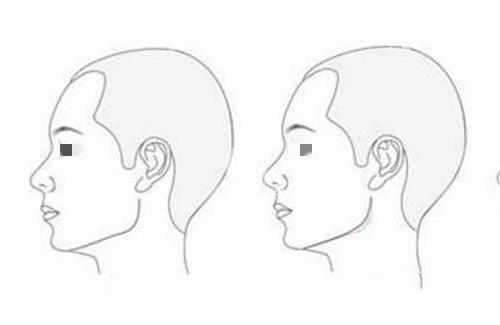 V-line瓜子脸手术是磨骨吗？从手术原理、技术方法等解析