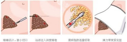 长沙梵童和艺脂抽脂哪家好？脂肪项目两家整形医院都可以放心选择呢！