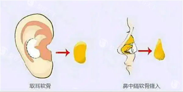 沧州京美鼻子整形真实术例:半肋软骨隆鼻解决塌鼻头,术后3个月鼻梁挺直,成效超自然!