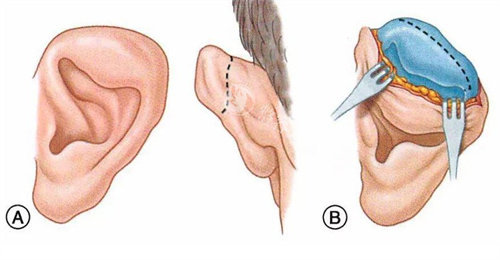 想了解耳朵再造？广州余文林医生改善好不好？患者亲述术后变化来啦！
