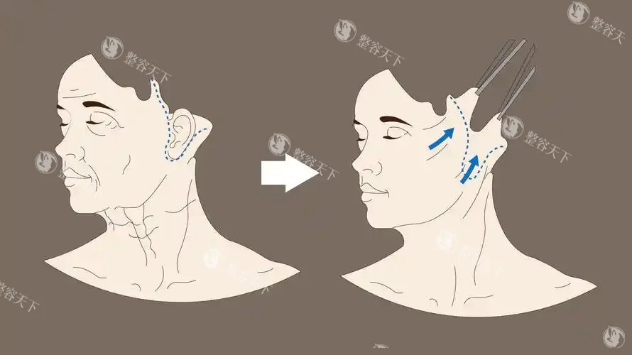做一次7D聚拉提能管几年？不同部位结果持续时间解析！