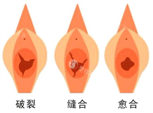 成都私密整形手术多少钱？2025处女膜修复3000元起、阴道紧缩术5000元起、阴唇整形4000元起！