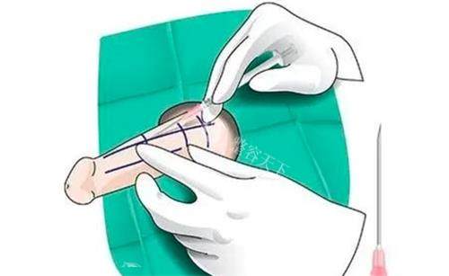 海绵体注射多少钱一针？一两千左右起步，价格差距比较大，主要看针剂品牌和注射量