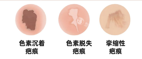 全盘解密!上海健桥医院治疗疤痕价格表揭晓,来看上海建桥疤痕修复中心费用高吗?