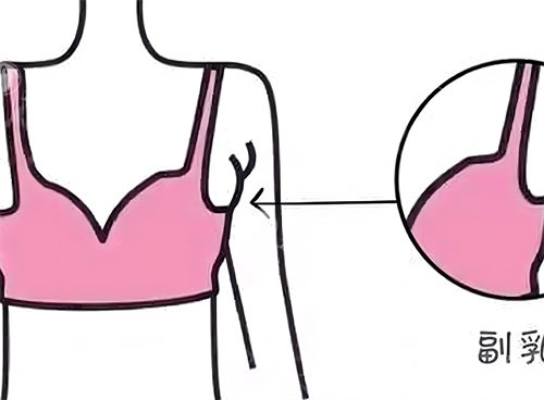副乳太烦恼，吸脂和手术哪个能一招搞定？来看两种去副乳深度对比！