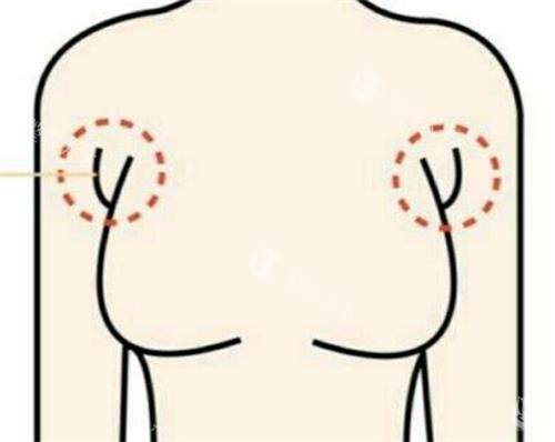 副乳太烦恼，吸脂和手术哪个能一招搞定？来看两种去副乳深度对比！