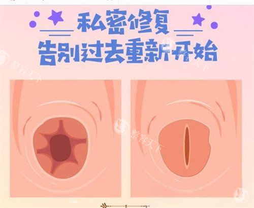 2025 处女膜修复手术价格表来了，不同地区、医生收费不同，选对很重要