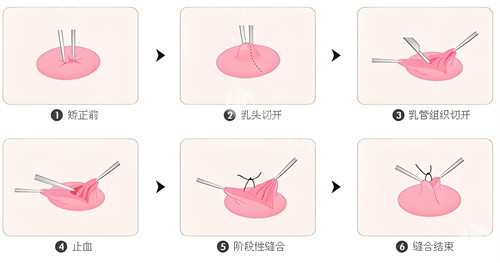 想做乳头内陷矫正手术，修复时间是多久？这篇文章给你答案！