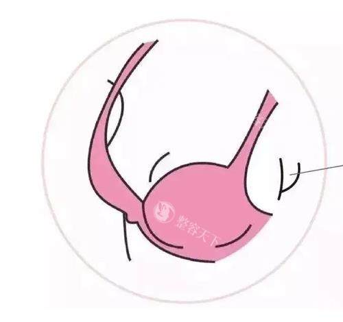 副乳太烦恼，吸脂和手术哪个能一招搞定？来看两种去副乳深度对比！