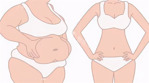 北京禾美嘉关几梦吸脂值得信赖！芭蕾纤腿平行术精密，打造满意腿型马甲线​