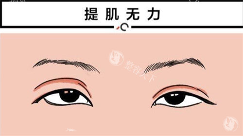 上眼皮提肌手术的结果能维持多长时间？维持5-10年没啥问题~