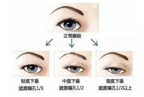 上眼皮提肌手术的结果能维持多长时间？维持5-10年没啥问题~