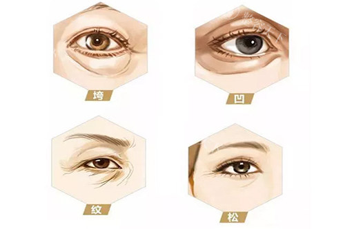 上眼皮提肌手术要花多少钱？3000 - 15000元之间！来看不同情况价格差在哪