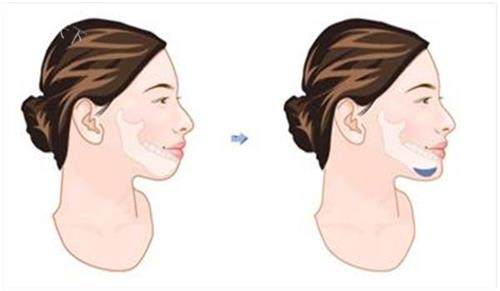 深圳下巴后缩矫正哪家医院好?玻尿酸4500起vs假体1.2w+|深圳口碑医院价格&医生全攻略