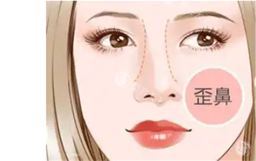 深圳罗志敏修复鼻子技术娴熟！自体软骨+个性化定制，不透光不排异，打造自然立体精致翘鼻​