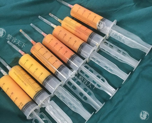 吸脂手术抽出来的脂肪照片