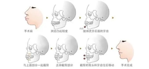 在上海做功能性的正颌手术报销吗？肯定能报销，基本上报销金额在3~4w，详览上海正颌报销流程及比例