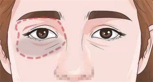 深圳朱冠峰不开刀去眼袋是真是假？从患者反馈来看是真的，都在说朱冠峰去眼袋没有切口还无尴尬期