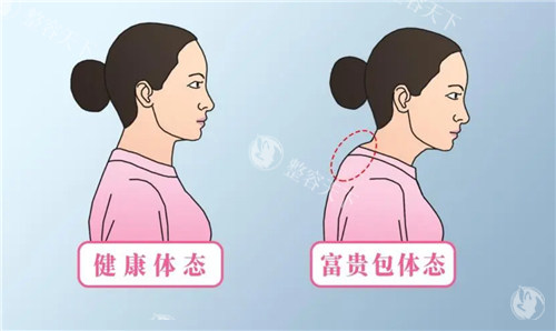 有无富贵包对比