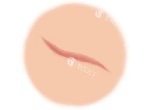 疤痕增生漫画示意图