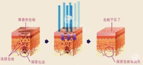 杏枝山祛斑真的有用吗？深度剖析原理、结果与价格，让你不再迷茫！