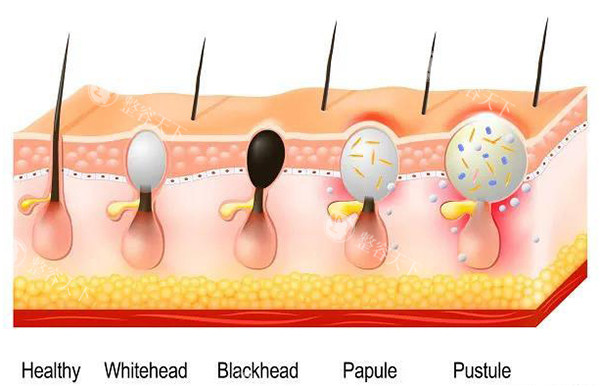 针清皮肤毛囊示意图
