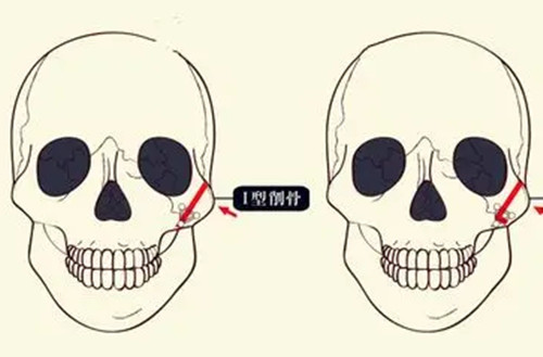 在重庆做颧骨/下颌角怎么选医生？肖林/罗恩/李继华哪个技术更好，本文摊开给你讲透