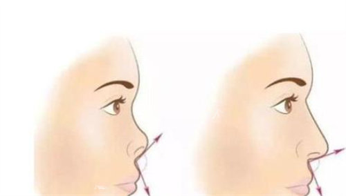 成都李萍医生隆鼻实录：自然之美，从“鼻”开始！整个面部轮廓看起来更加协调美观