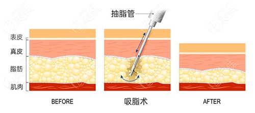西安吸脂比较好的医生：窦玺、王鹏、陈伟、王恒、王仁根五位医生请认准！吸脂技术高、口碑好、审美在线~