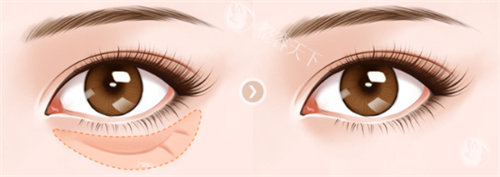 贺焕焕眼袋变卧蚕怎么样？郑州整形医生详解技术：外切祛袋+动态卧蚕塑形9310元起