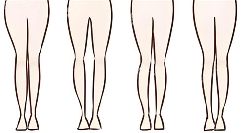 郑州东方整形李冰直腿术靠谱吗？真实实例+技术解析，告别O型腿/X型腿烦恼！