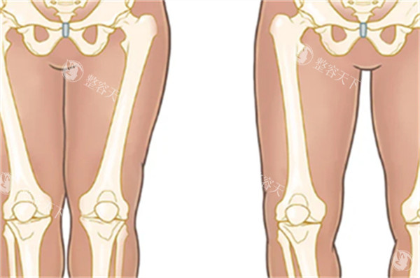 O型腿和直腿的区别图解