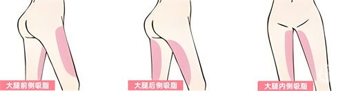 腿部吸脂部位展示动画图