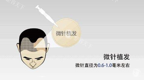 我去碧莲盛花6万做了植发|4000单位不剃发技术|术后结果真实反馈