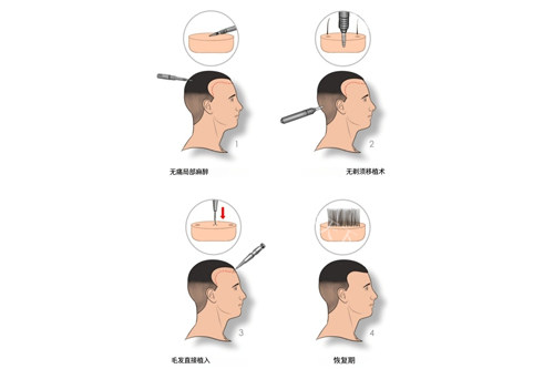 不剃发植发示意图