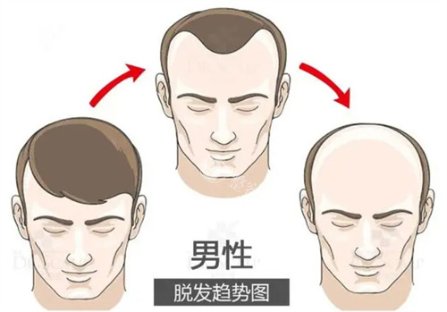 广州植发正规医院排名前三名揭晓！微针修复疤痕低至1881元，这三家植发技术谁更胜一筹？