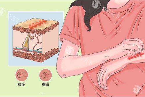 疤痕增生引起的症状示意图