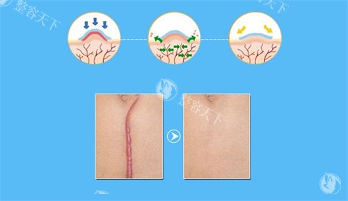 武汉SRT100治疗疤痕疙瘩多少钱?3000-5000元/次|3-5次疗程|疙瘩变平超开心!